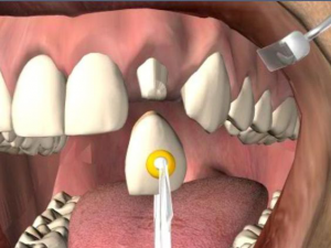 crowns last on teeth