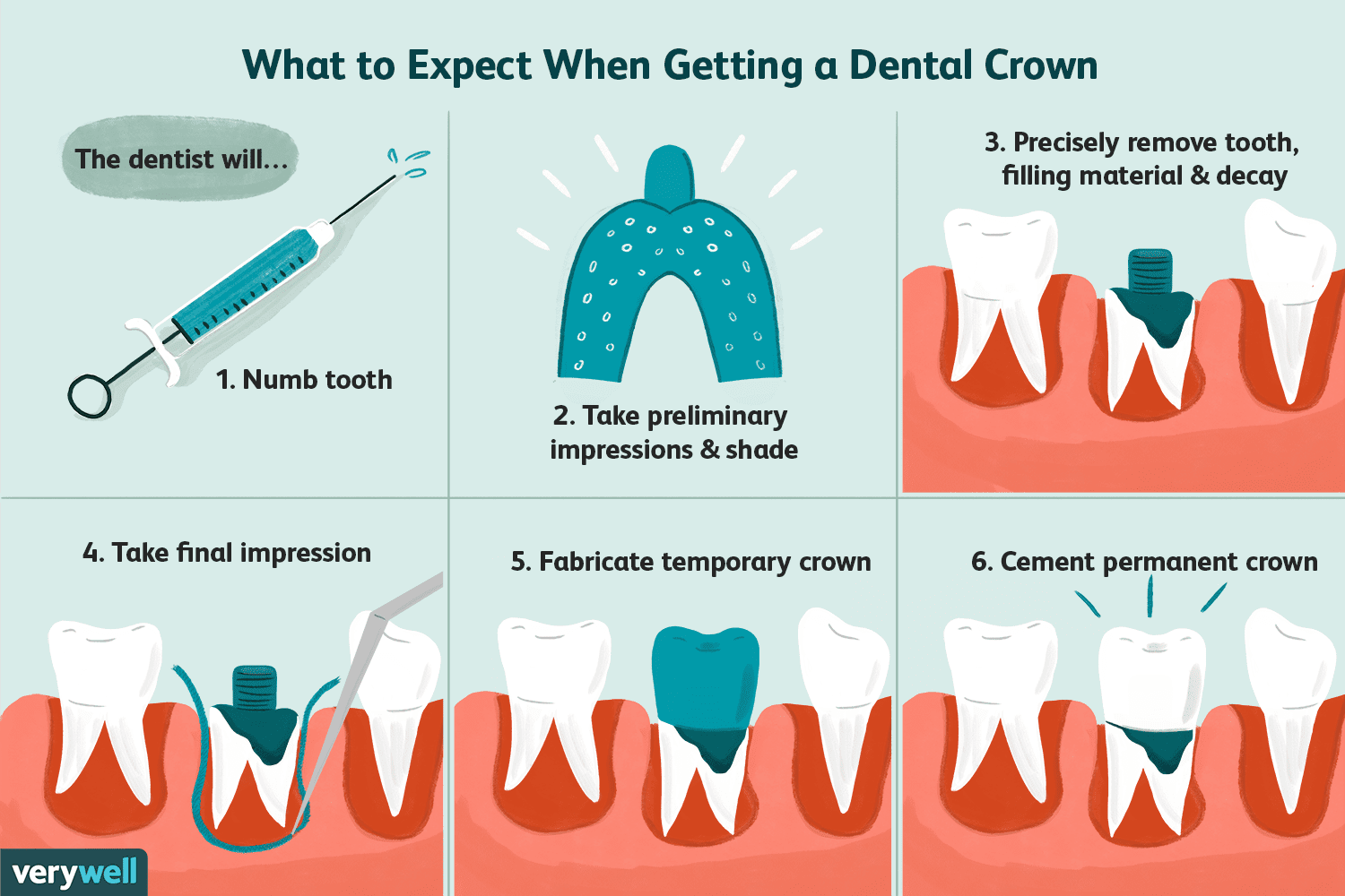 Is it painful to have a crown put on your tooth?