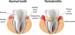 gum disease is serious