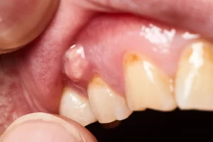  tooth decay under a crown