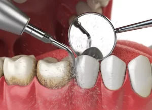 What is involved with a dental clean?