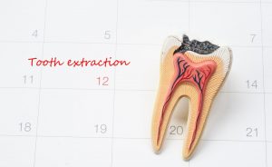 How much does a tooth extraction cost in Australia?