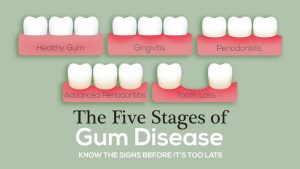 What does gum disease start like?