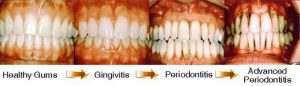 What does stage 4 gum disease look like?