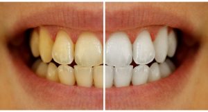 How can I clean my yellow teeth?