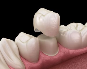 How long do crowns last on teeth?