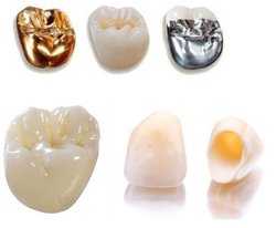 What are the 3 types of crowns?