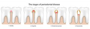 What are three signs of gum disease?