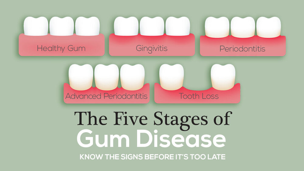 What are three signs of gum disease?