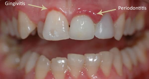 Can you fix gum disease?