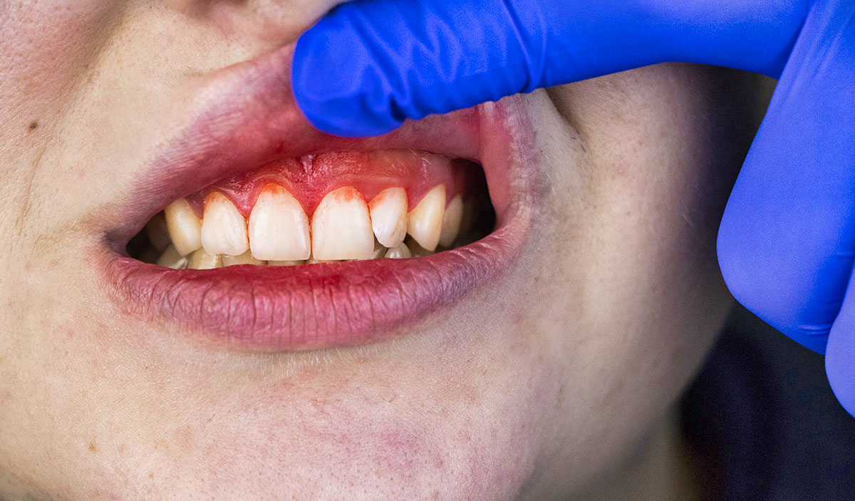 What does gum disease start like?
