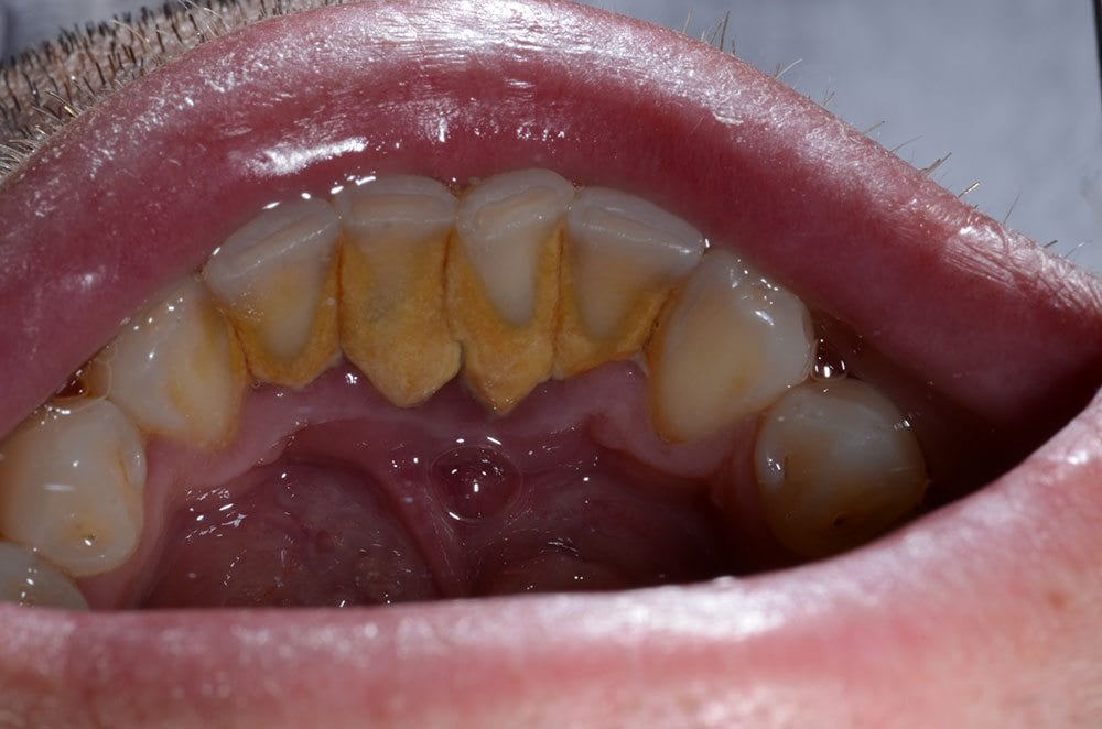 How do I know if my gum disease is serious?