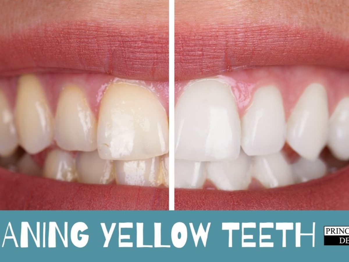 How can I clean my yellow teeth?