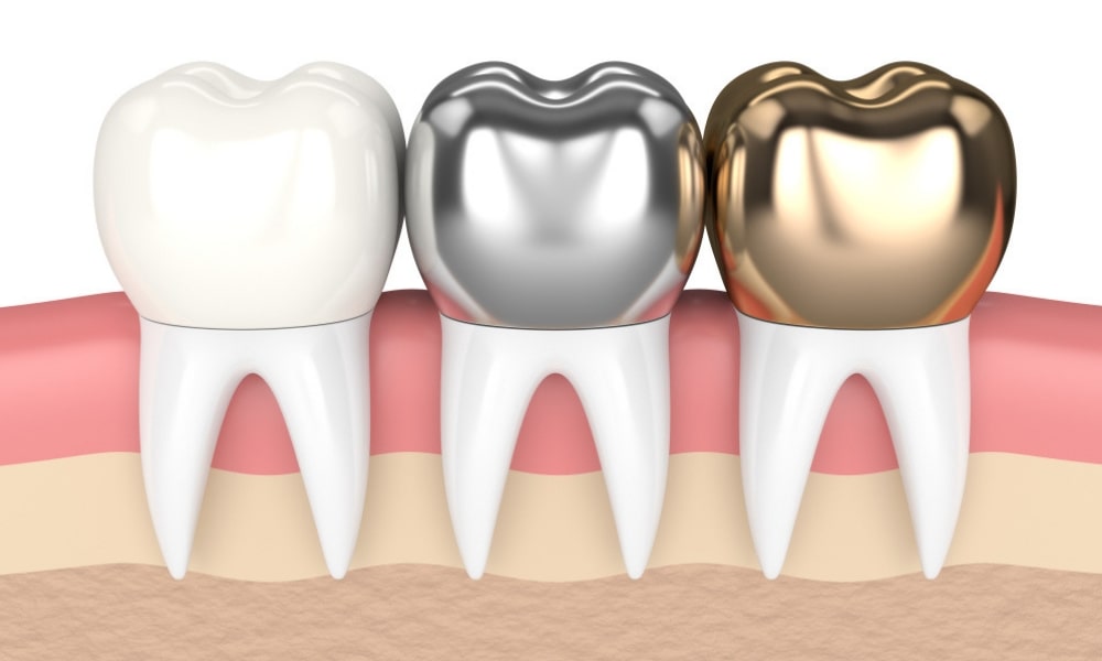 How long do crowns last on teeth?