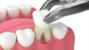 recover from a dental extraction