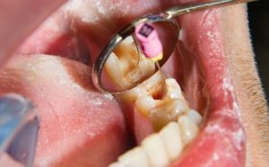 How much is teeth cleaning in Australia?