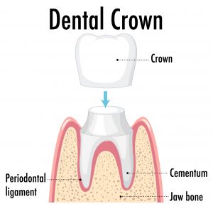 3 types of crowns