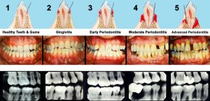 signs of gum disease