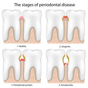 gum disease