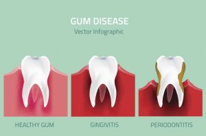 How do you fix gum disease on your teeth?