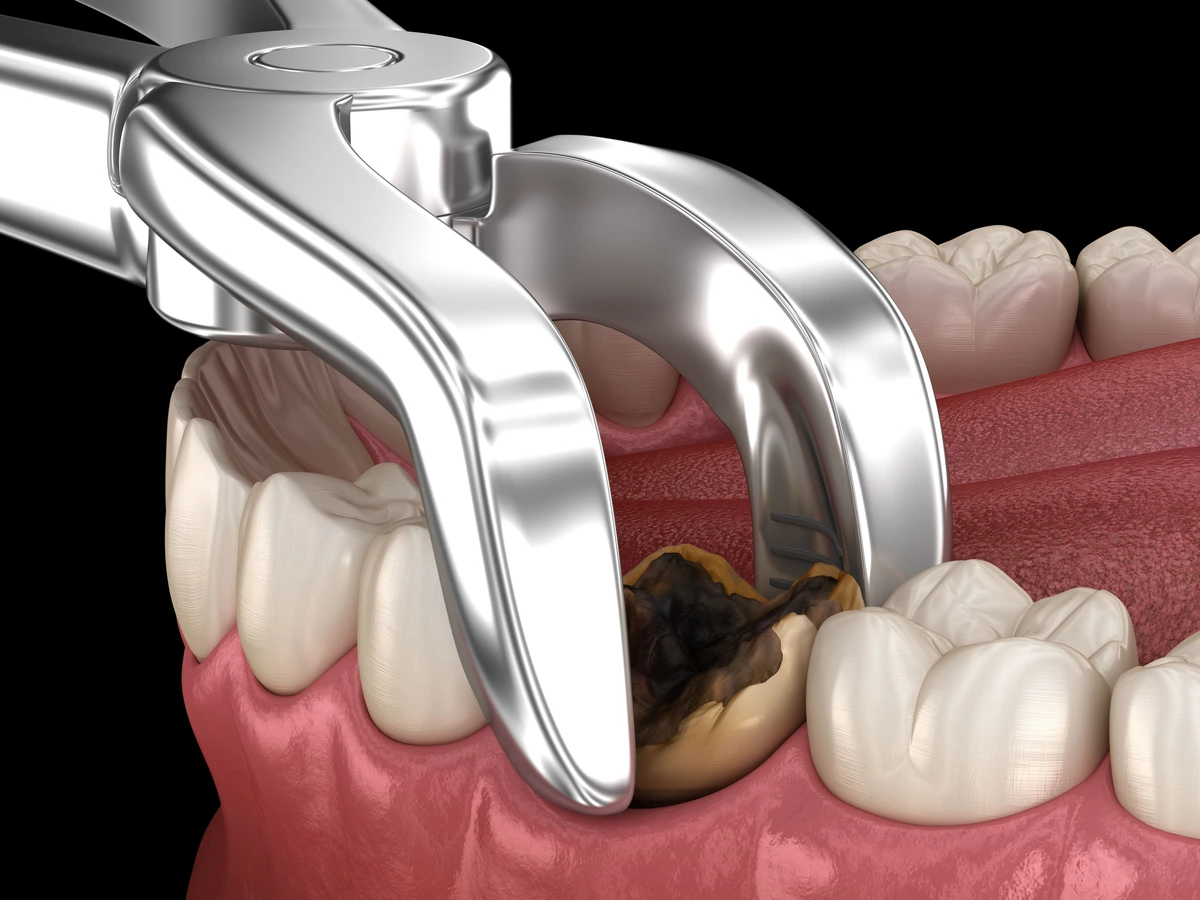 Should decayed tooth be removed?