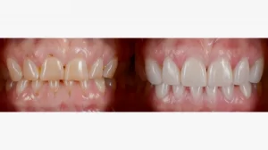 veneers cost