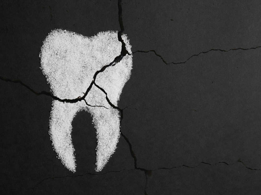 What are four 4 signs of tooth decay?