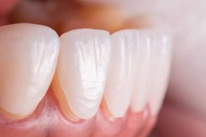 normal teeth after veneers