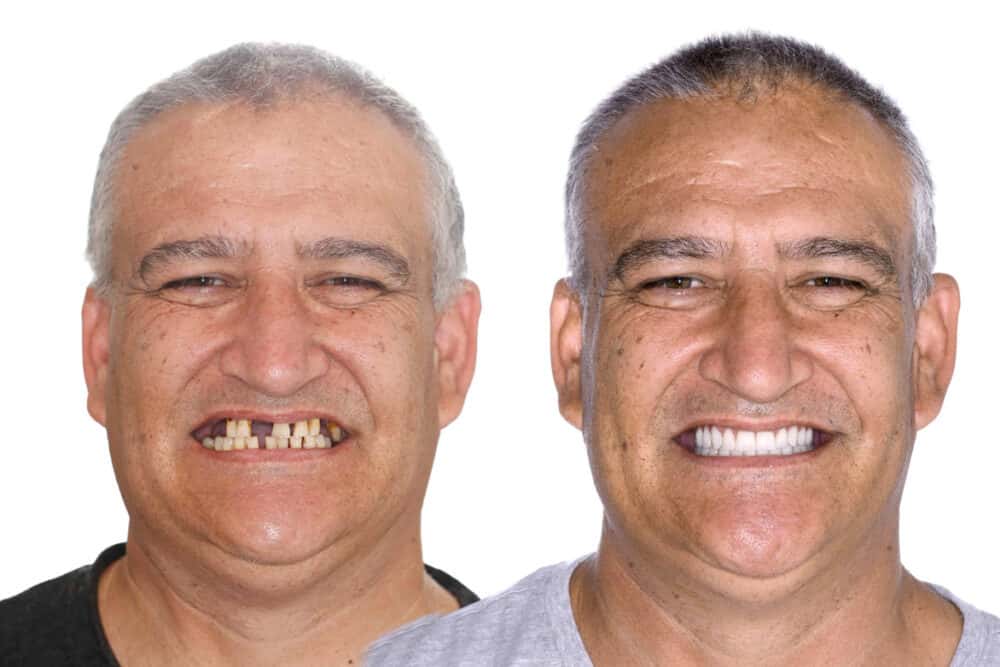 do-pensioners-get-free-dentures-in-australia