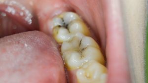 How long can you keep a decayed tooth?