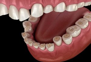 How do dentists treat enamel loss?