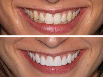 How much do veneers cost in Australia?