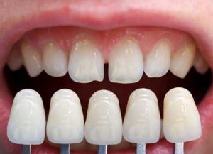 Can veneers be covered by Medicare?