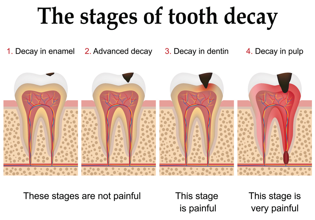 Can tooth decay be fixed?