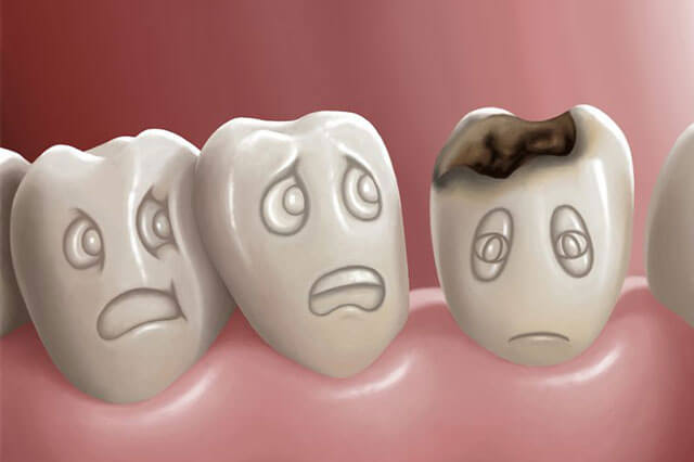 How long can you keep a decayed tooth?
