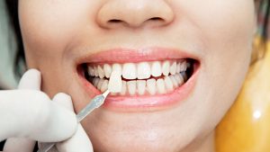 teeth veneers last