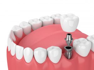 How much does 2 false teeth cost?