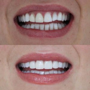 How much does veneers cost?