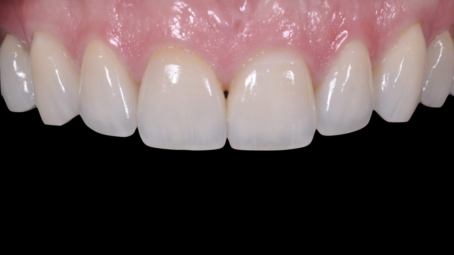 How long do teeth veneers last?