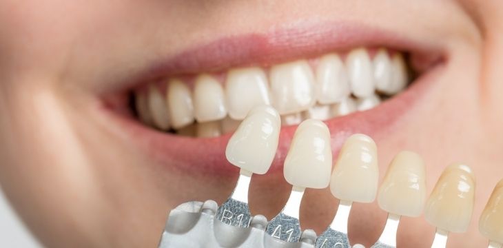 Can you go back to normal teeth after veneers?