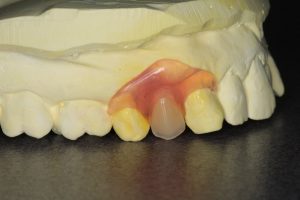 denture for one tooth