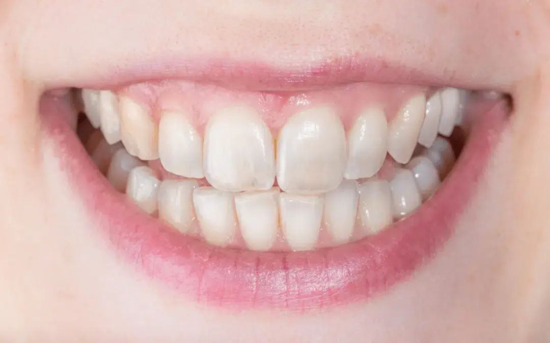 How do you know if your enamel is gone?