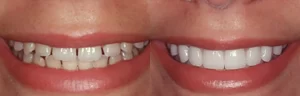 veneers painful to get