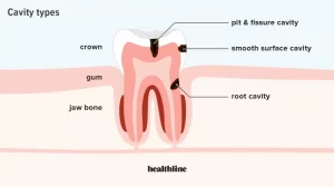 How can you treat a tooth decay?