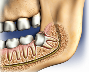 decayed tooth be removed