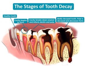 can you treat a tooth decay