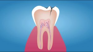 Should decayed tooth be removed?