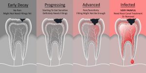 tooth decay be fixed