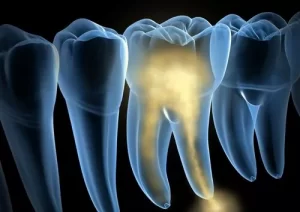 What are the symptoms of tooth nerve damage?