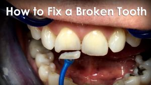 What is the cheapest way to repair a broken tooth?